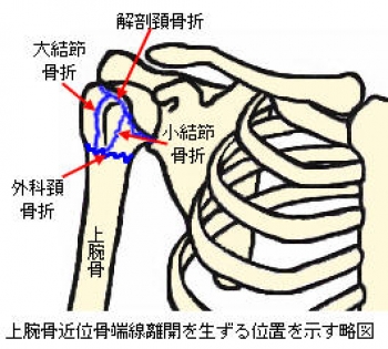 骨折 上腕骨骨折 上部 編 ブログ ねんざ 交通事故治療は ながの鍼灸接骨院